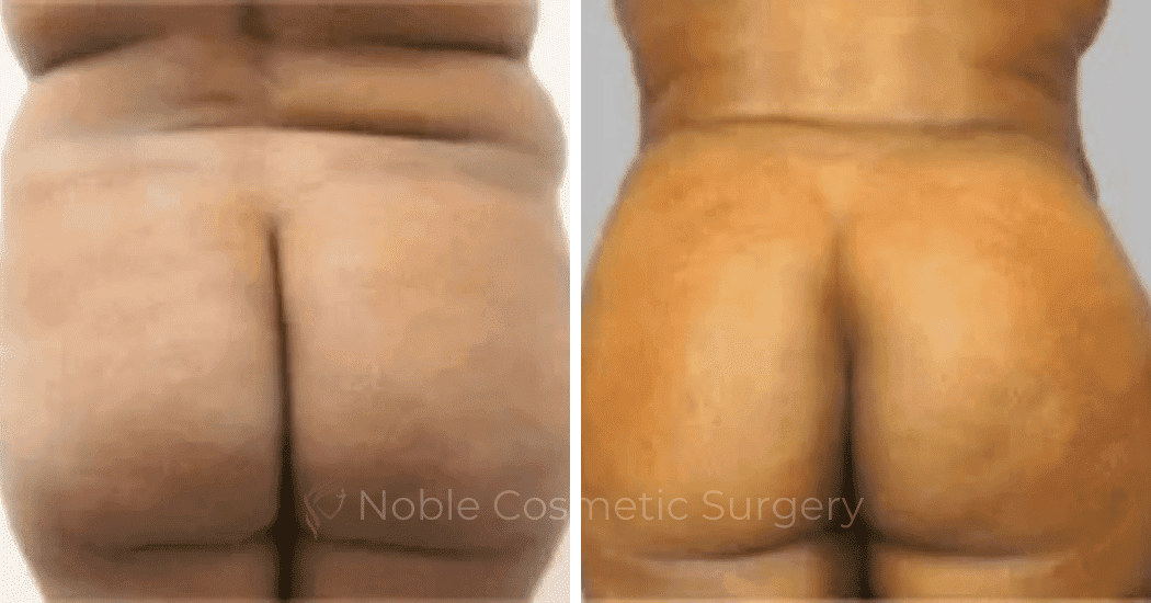 Brazilian-Butt-Lift-Case-15110 | Before and After Brazilian Butt Lift