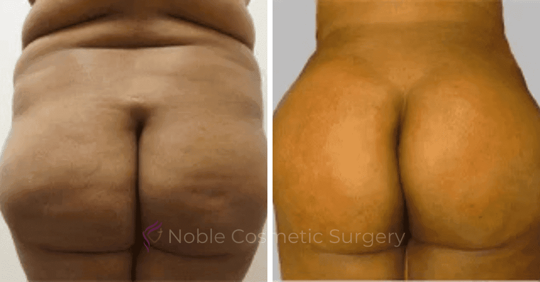 Brazilian-Butt-Lift-Case-15111 | Before and After Brazilian Butt Lift