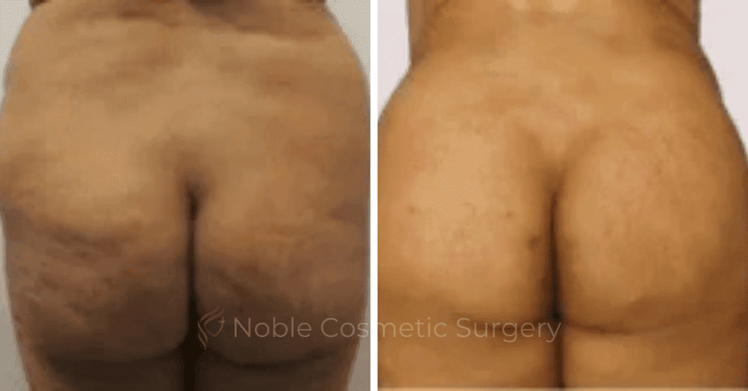 Brazilian-Butt-Lift-Case-15112 | Before and After Brazilian Butt Lift