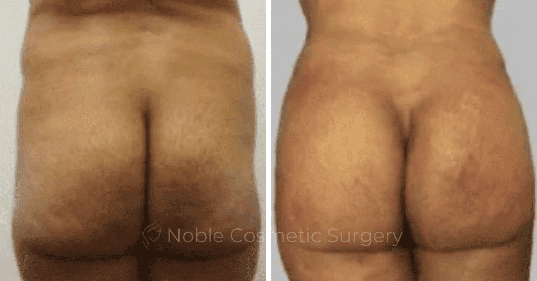 Brazilian-Butt-Lift-Case-15113 | Before and After Brazilian Butt Lift