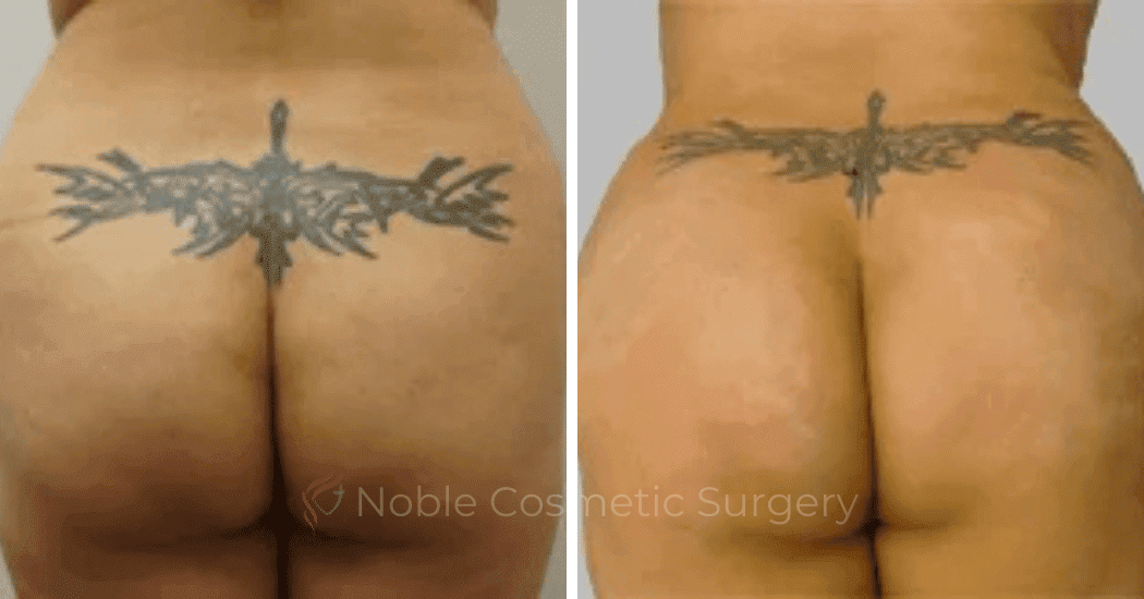 Brazilian-Butt-Lift-Case-15116 | Before and After Brazilian Butt Lift