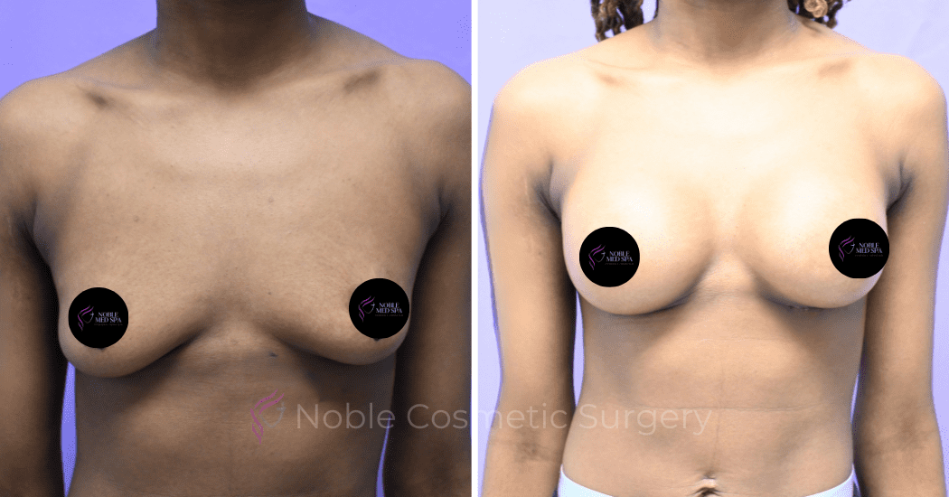 BREAST-AUGMENTATION--CASE-19521 | Before and After Breast Augmentation
