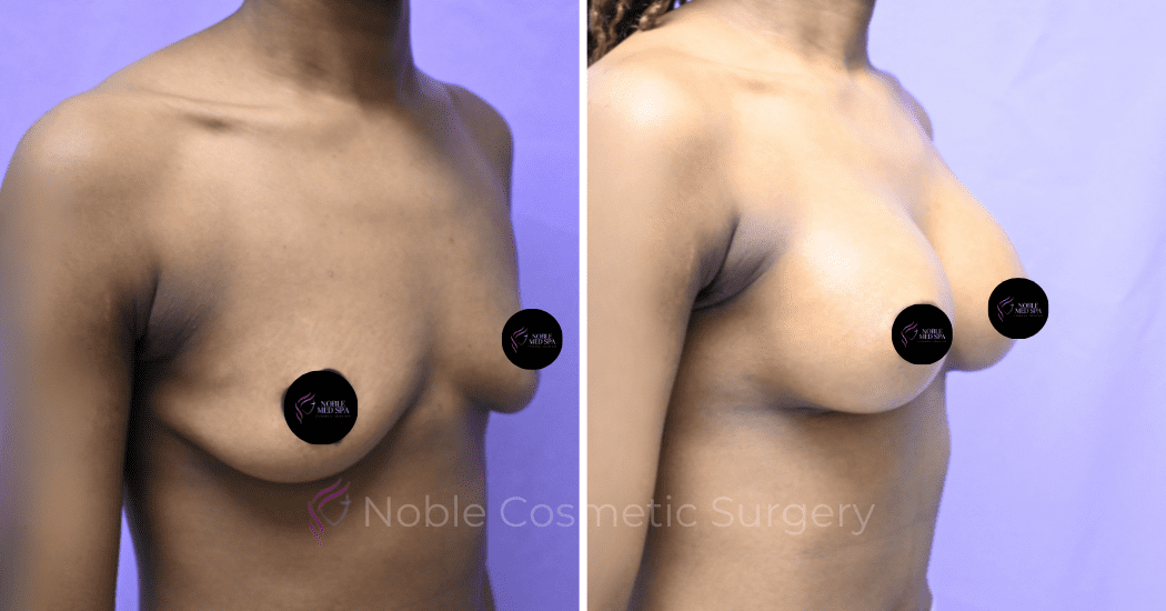 BREAST-AUGMENTATION--CASE-19521 | Before and After Breast Augmentation 2