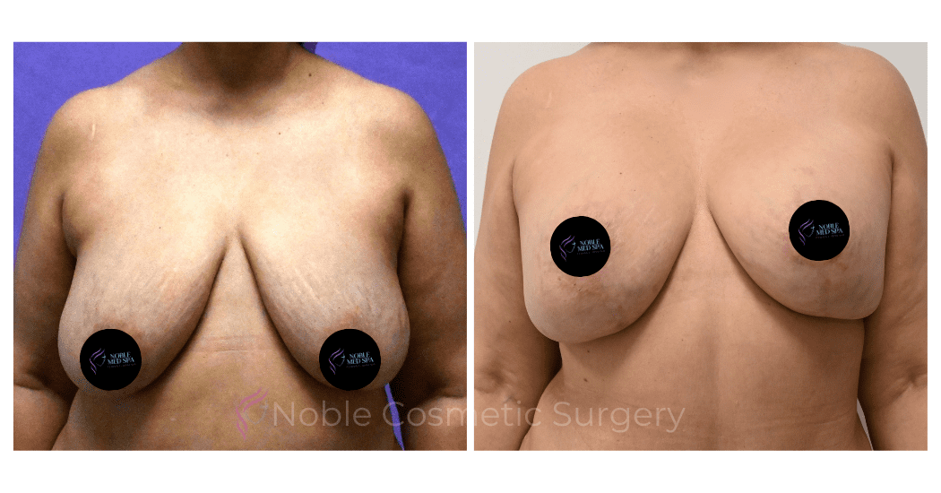 BREAST-REDUCTION-CASE-00220 | Before and After Breast Reduction
