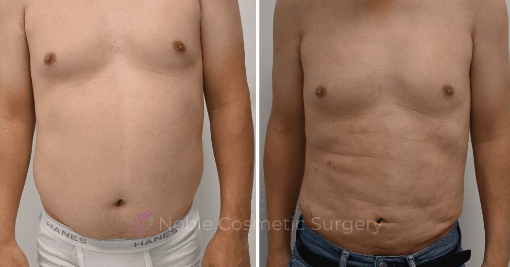 LIPOSUCTION-ABDOMEN-CASE-12252 | Before and After Male Liposuction