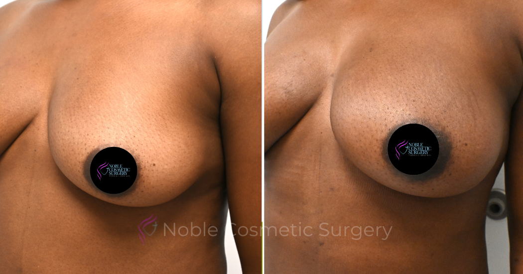 BREAST-AUGMENTATION--WITH-FAT-TRANSFER--CASE-10946 | Before and After Breast Augmentation 2