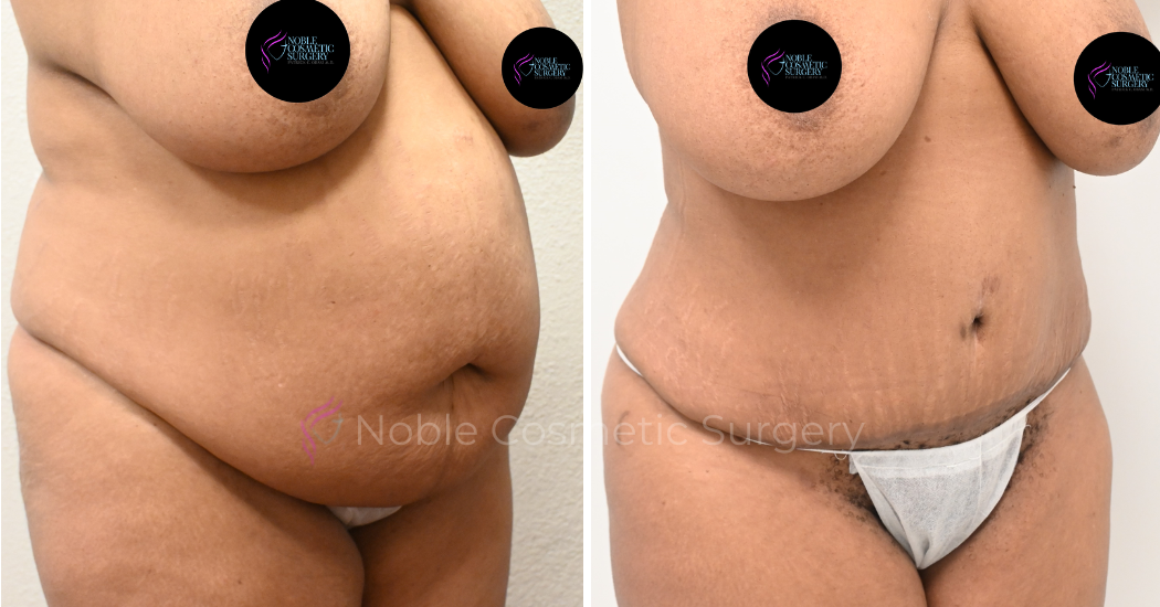 TUMMY-TUCK-CASE-00035 | Before and After Abdominoplasty 2