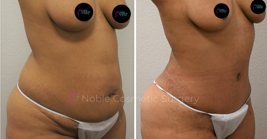 TUMMY-TUCK-CASE-00040 | Before and After Abdominoplasty 2