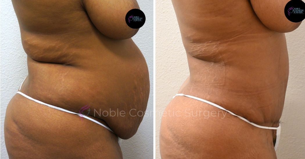 TUMMY-TUCK-CASE-00033 | Before and After Abdominoplasty 2
