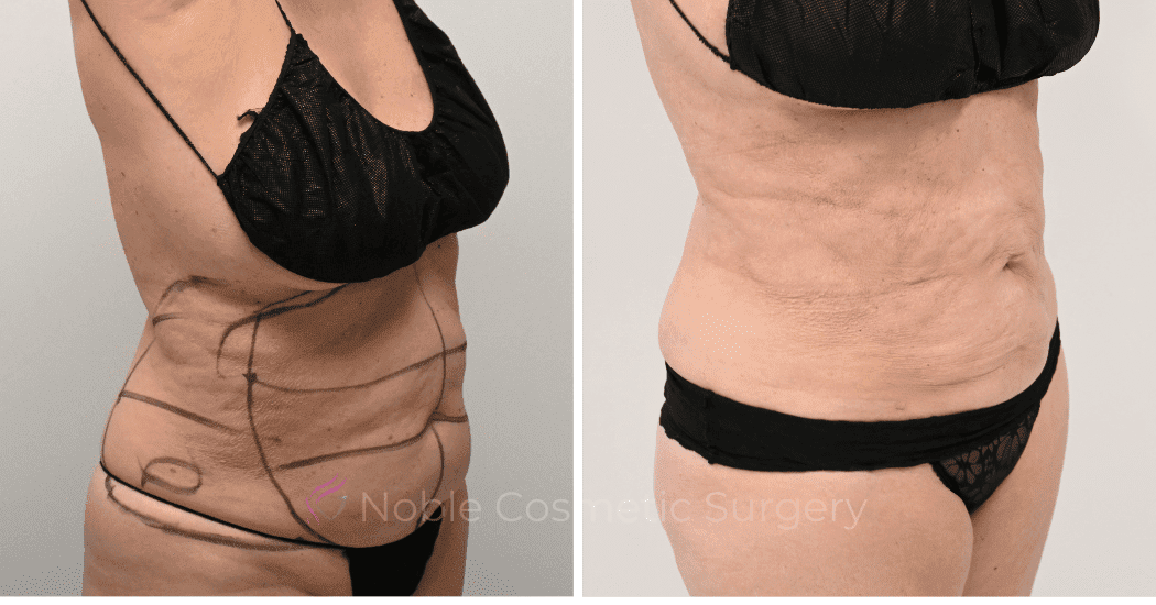 LIPOSUCTION-CASE-10145 | Before and After Liposuction 5