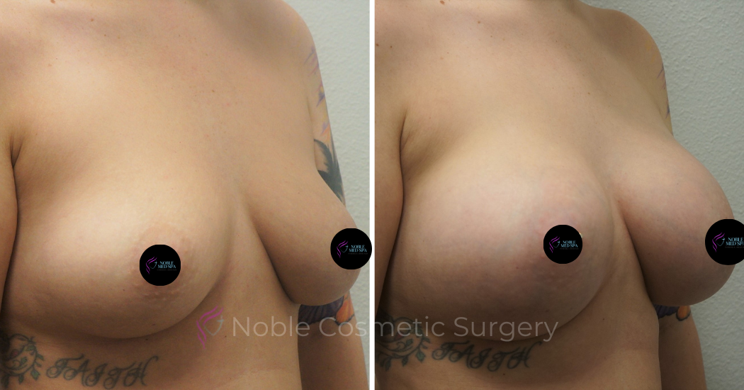 BREAST-AUGMENTATION--WITH-LIFT--CASE-00311 | Before and After Breast Augmentation with Lift 2