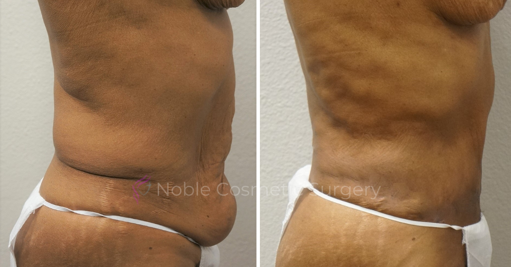 TUMMY-TUCK-CASE-00050 | Before and After Abdominoplasty 2