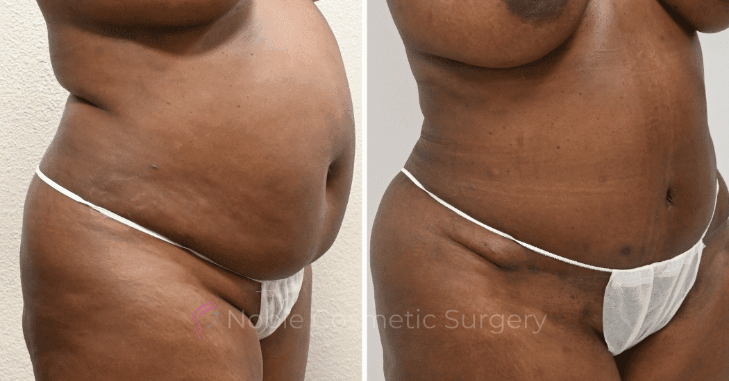 TUMMY-TUCK-CASE-13477 | Before and After Abdominoplasty 2