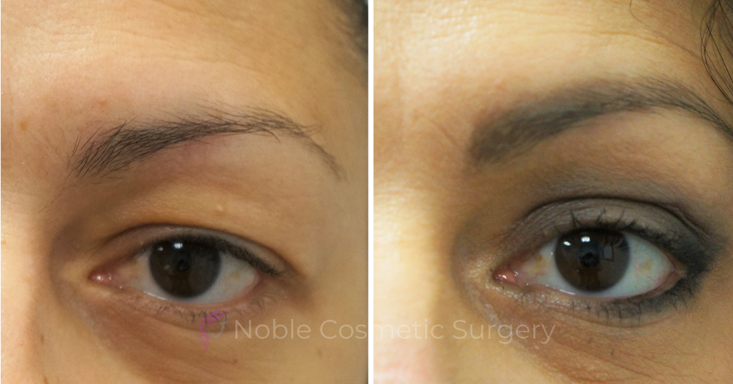 BLEPHAROPLASTY-CASE-16936 | Before and After Blepharoplasty