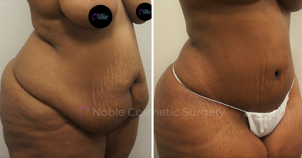 TUMMY-TUCK-CASE-00051 | Before and After Abdominoplasty 2