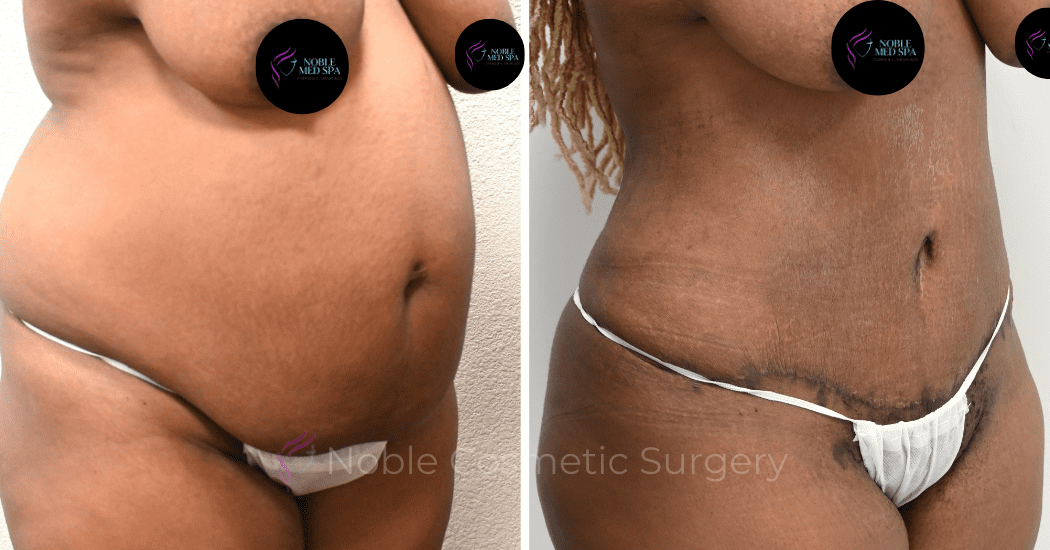 TUMMY-TUCK-CASE-13859 | Before and After Abdominoplasty 2