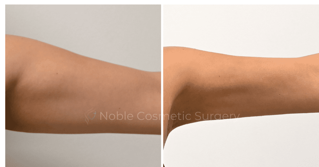 LIPOSUCTION-ARMS-CASE-00316 | Before and After Arm Liposuction