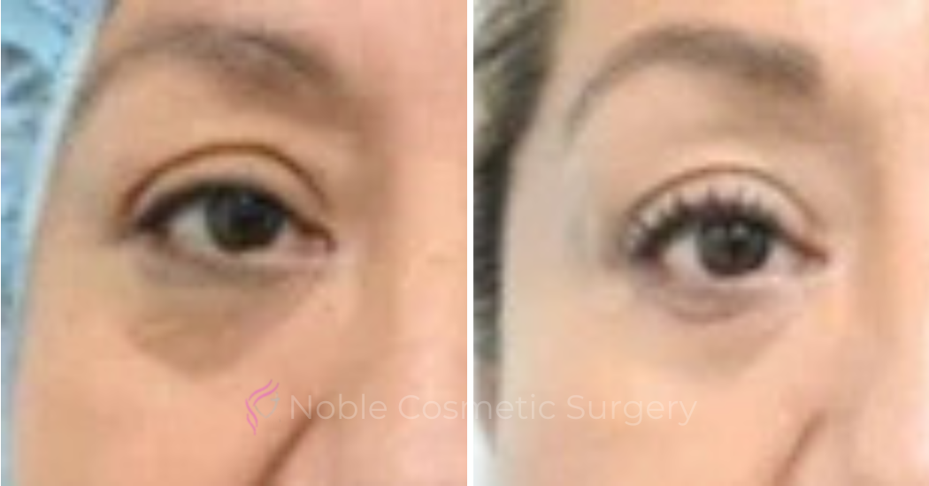 BLEPHAROPLASTY-CASE-00254 | Before and After Blepharoplasty 2