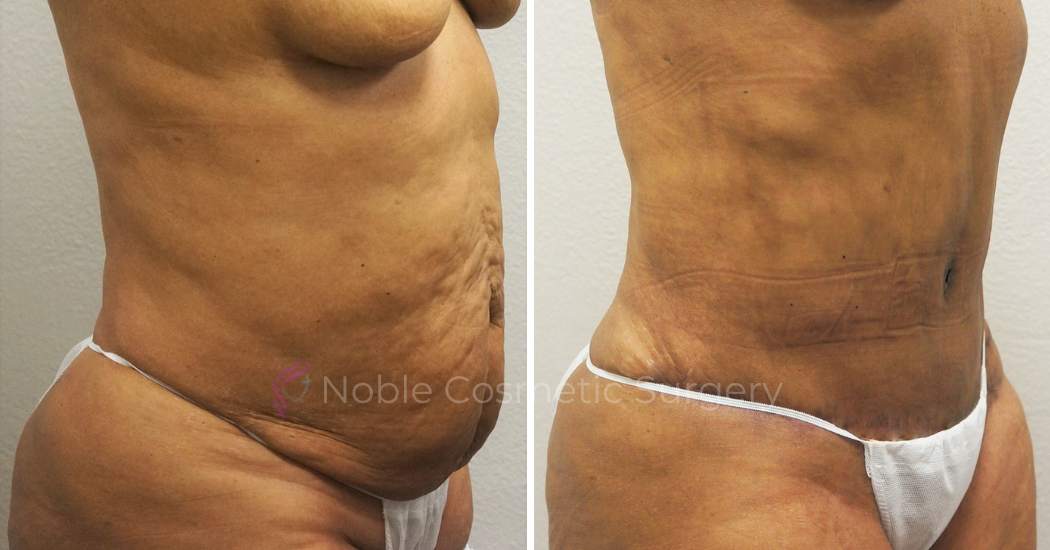 TUMMY-TUCK-CASE-00052 | Before and After Abdominoplasty 2