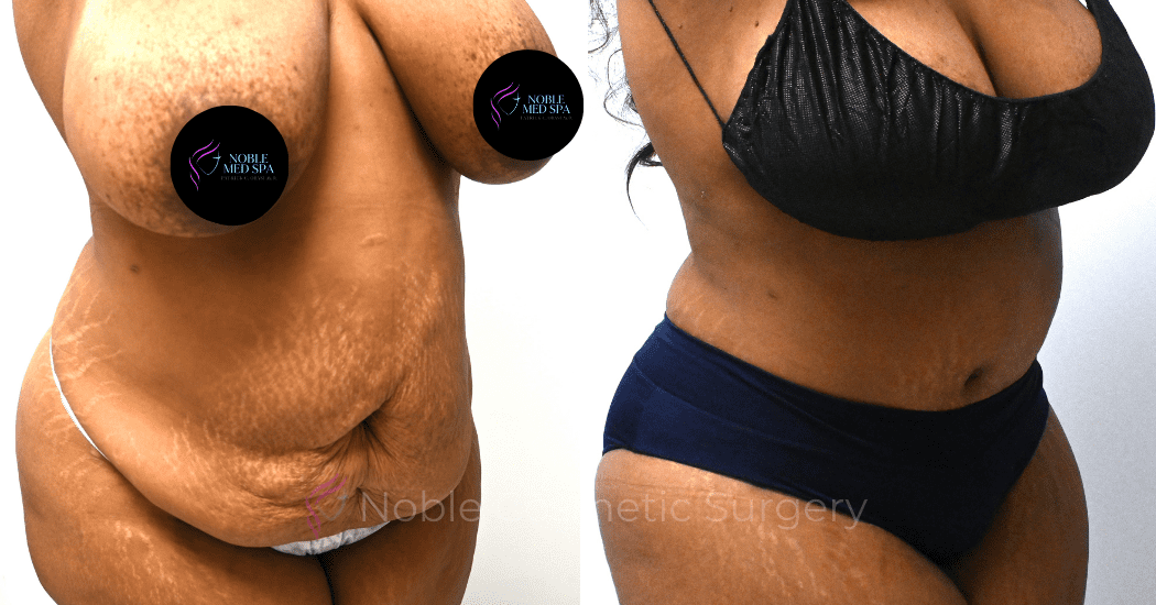 TUMMY-TUCK-CASE-14522 | Before and After Abdominoplasty 2