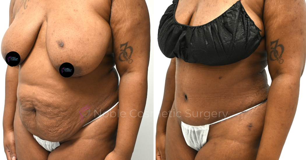 TUMMY-TUCK-CASE-00308 | Before and After Abdominoplasty 3