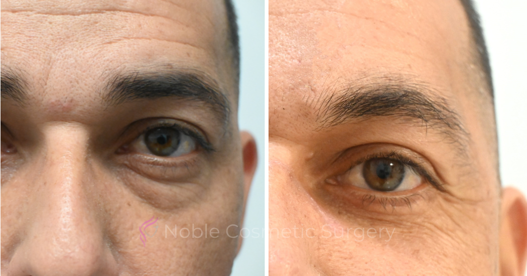 BLEPHAROPLASTY-CASE-10655 | Before and After Blepharoplasty