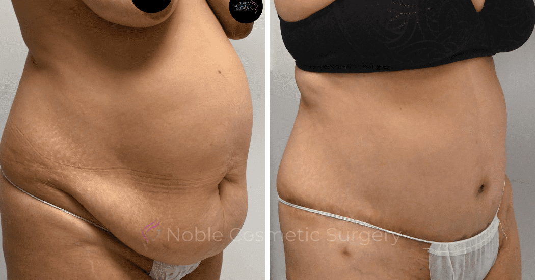 TUMMY-TUCK-CASE-11285 | Before and After Abdominoplasty 2