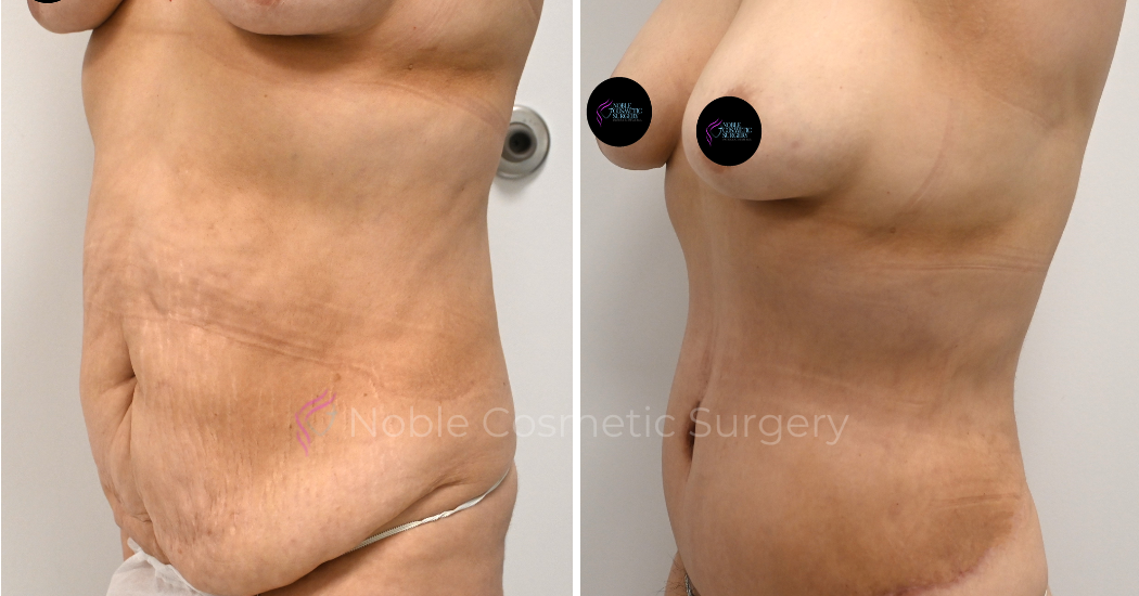 TUMMY-TUCK-CASE-00317 | Before and After Abdominoplasty 3