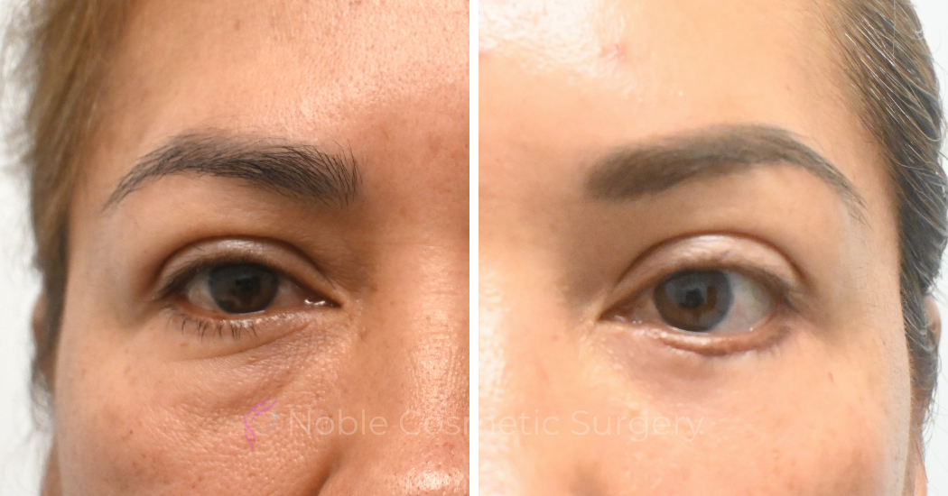 BLEPHAROPLASTY-CASE-19072 | Before and After Blepharoplasty 2