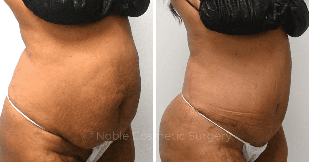 TUMMY-TUCK-CASE-10626 | Before and After Abdominoplasty 2