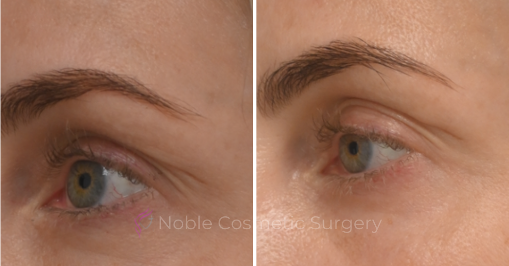 BLEPHAROPLASTY-CASE-10182 | Before and After Blepharoplasty 2