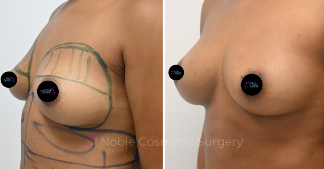 BREAST-AUGMENTATION--WITH-FAT-TRANSFER--CASE-11111 | Before and After Breast Augmentation 2