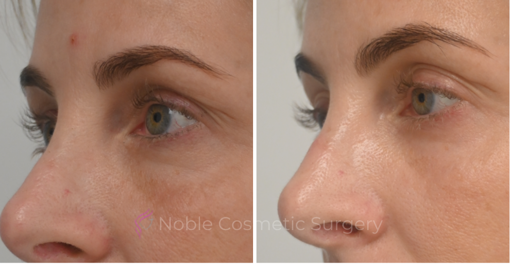 LIQUID-RHINOPLASTY-CASE-10007 | Before and After Liquid Rhinoplasty 2