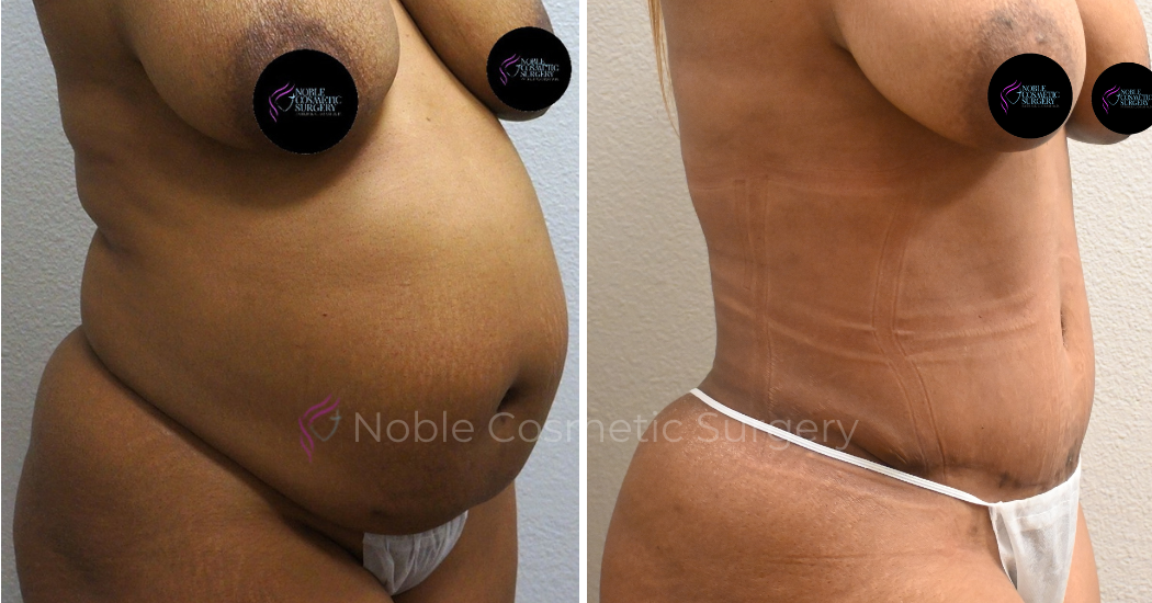 TUMMY-TUCK-CASE-00034 | Before and After Abdominoplasty 2