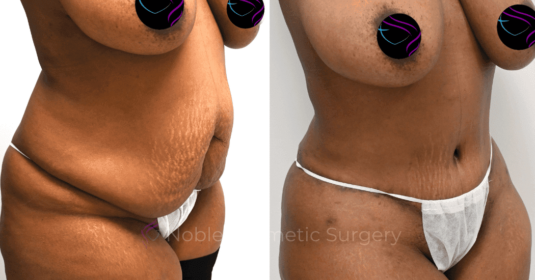 TUMMY-TUCK-CASE-14435 | Before and After Abdominoplasty 2