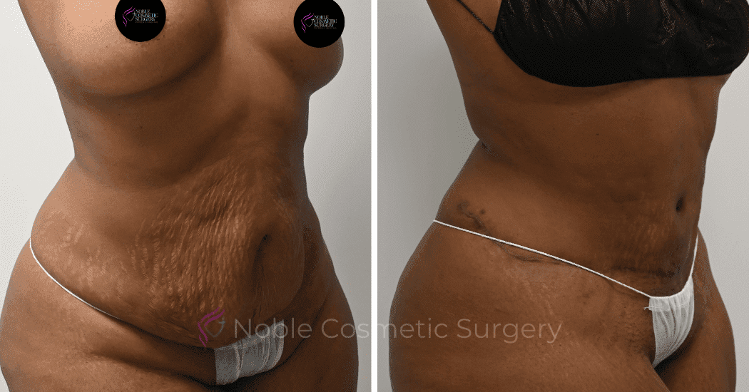 TUMMY-TUCK-CASE-14814 | Before and After Abdominoplasty 2