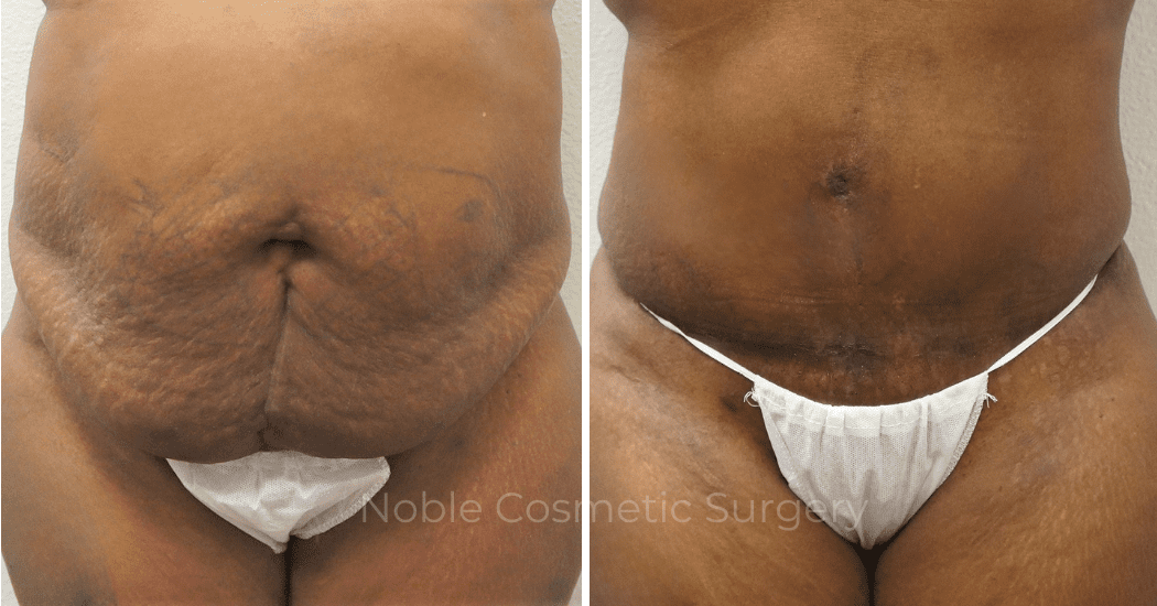TUMMY-TUCK-CASE-00303 | Before and After Abdominoplasty 1