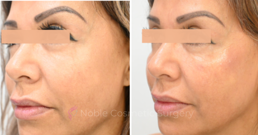 LIQUID-RHINOPLASTY-CASE-10004 | Before and After Liquid Rhinoplasty 2