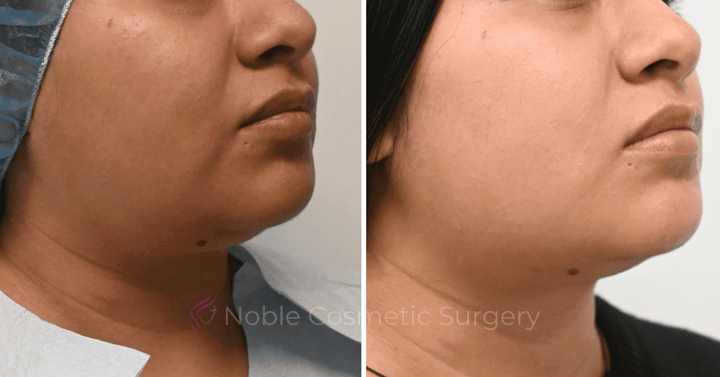 SUBMENTAL-LIPOSUCTION-CASE-10071 | Before and After Chin Liposuction 2