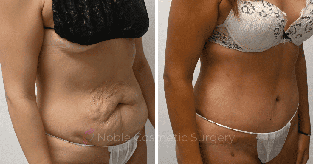 TUMMY-TUCK-CASE-12792 | Before and After Abdominoplasty 2