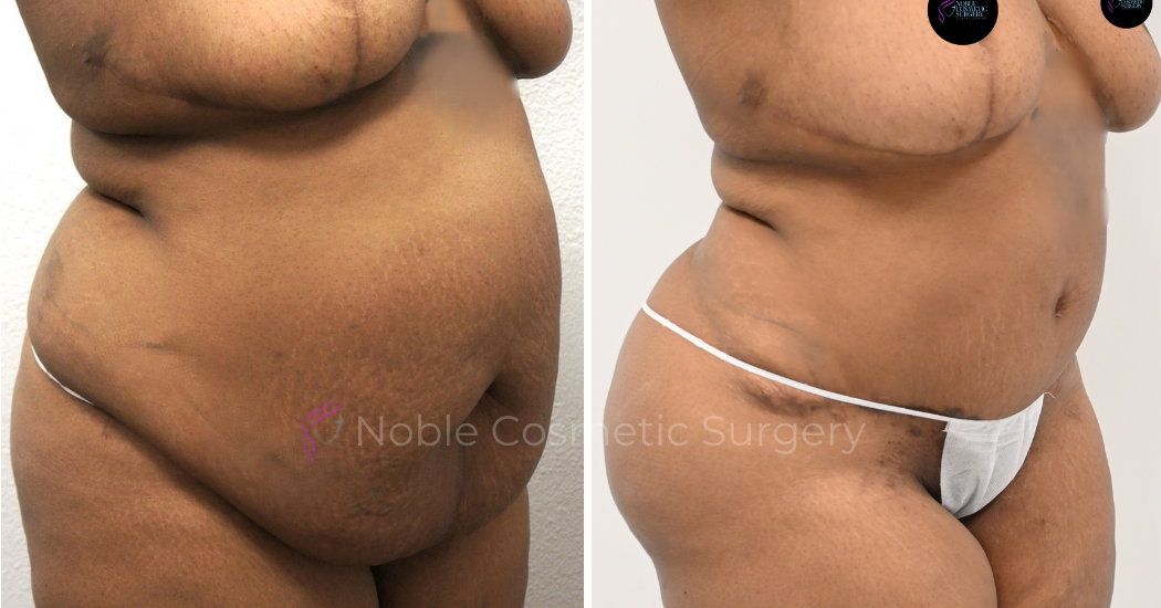 TUMMY-TUCK-CASE-00038 | Before and After Abdominoplasty 2