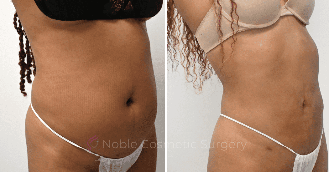 LIPOSUCTION-ABDOMEN-CASE--10533 | Before and After Liposuction 2
