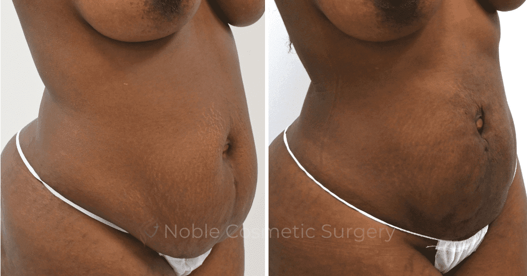 LIPOSUCTION-ABDOMEN-CASE-12901 | Before and After Liposuction 2