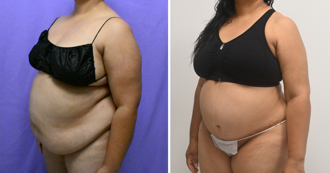 Case--10177 | Before and After Abdominoplasty 2