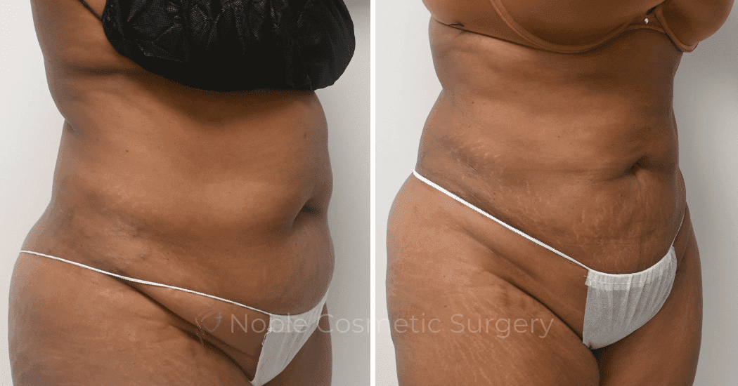 LIPOSUCTION-ABDOMEN-CASE-16787 | Before and After Liposuction 2
