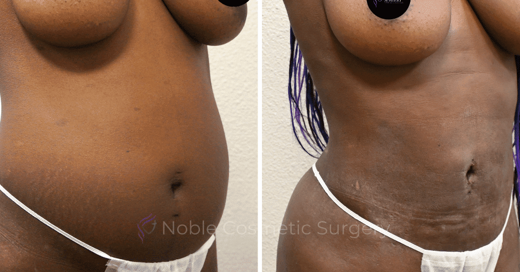 LIPOSUCTION-ABDOMEN-CASE-15104 | Before and After Liposuction 2