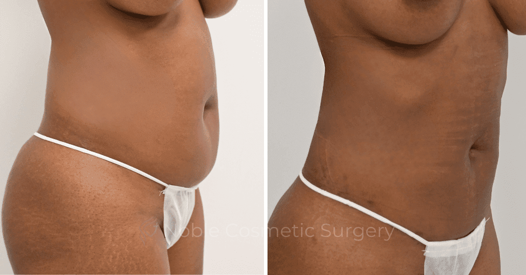 LIPOSUCTION-ABDOMEN-CASE-12590 | Before and After Liposuction 2