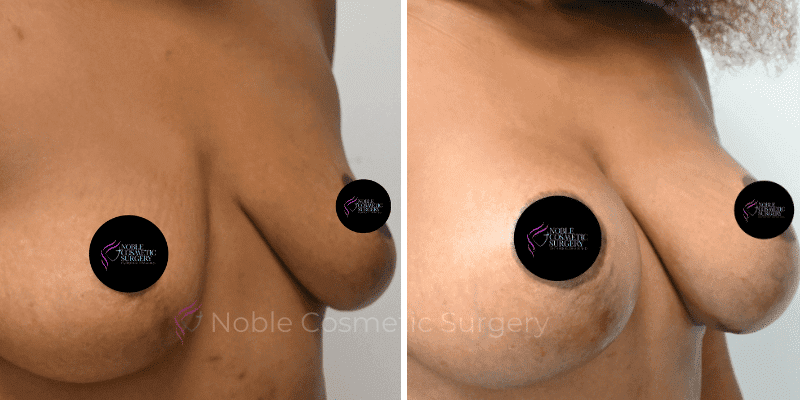 BREAST-AUGMENTATION-CASE-11356 | Before and After Breast Augmentation 2