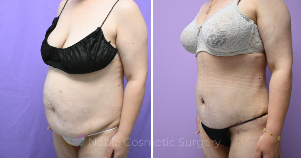 Case--19794 | Before and After Abdominoplasty 2
