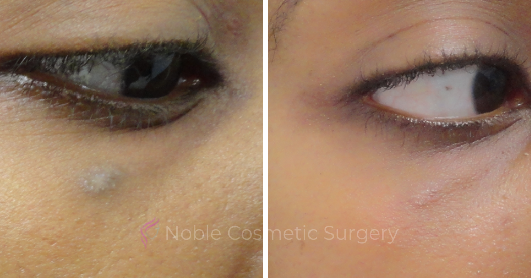 PICO-LASER-CASE-00001 | Before and After Pico Skin Rejuvenation